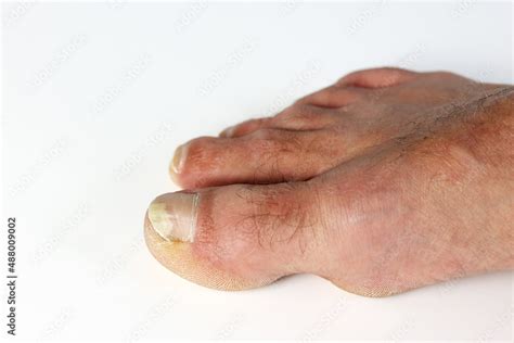 Close up fungus toenail disease, the fungus infects the areas between ...