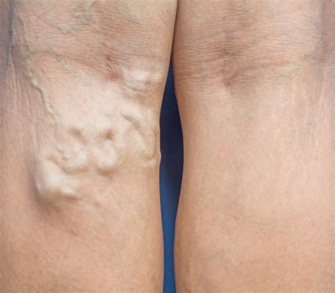 3 Reasons to Treat Your Swollen Veins Now | MIMIT Health - MIMIT Health
