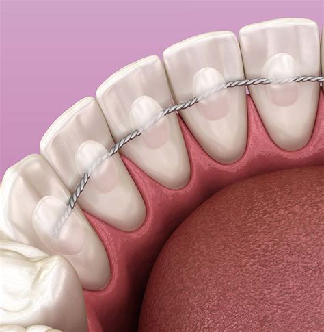 retainers dr erfan salloum specialist orthodontist  dublin
