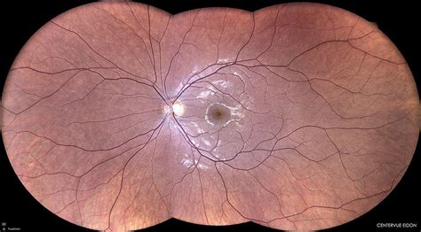 fundus photography retina center  san diego