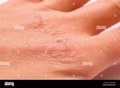 scars   hand  white background stock photo alamy