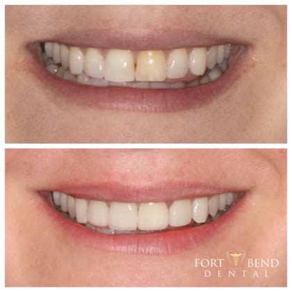 4 Veneers on Top Front Teeth - Veneers - Before and After Gallery