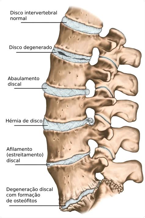 O'que É Discopatia Degenerativa