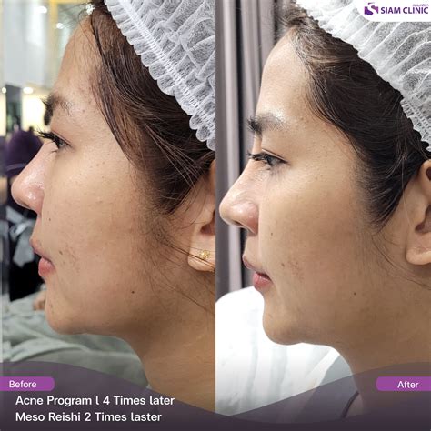 Acne Treatment Before and After Photos - Siam Clinic Thailand