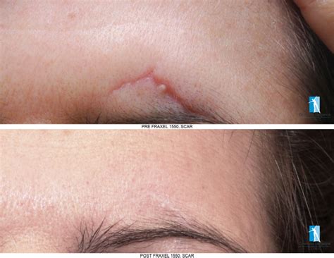 Scar Revision - Cosmetic Elegance
