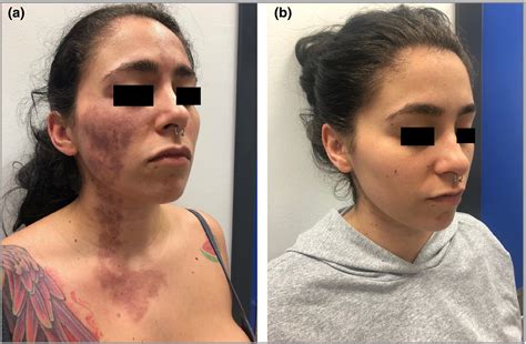 image gallery recurrent headache  facial ecchymosis garciasouto