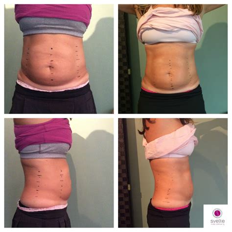 Body contouring before and after | Lipo cavitation before and after ...
