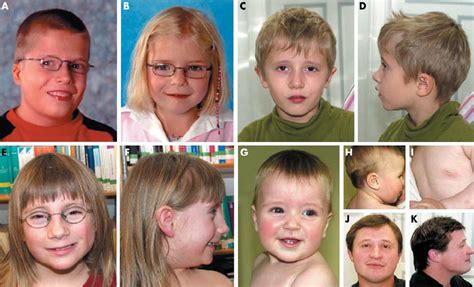 Digeorge Syndrome Facial Features