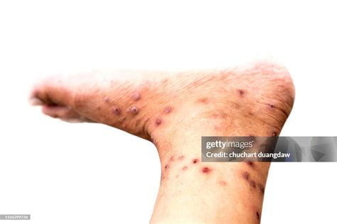 Skin Allergy With Dermatitis Problem Of Rash Allergy Rash And Health ...