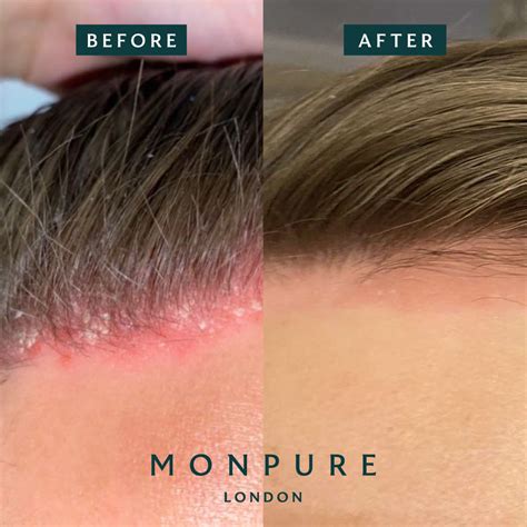 Psoriasis Scalp Treatment Natural