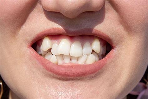 overcrowded teeth fix  fast  expert guide costs treatment