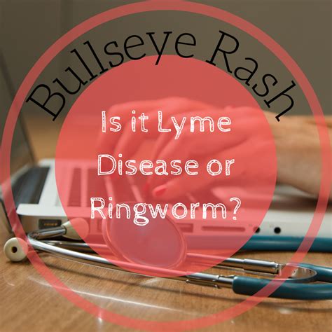 Bullseye Rashes: Ringworm and Lyme Disease Differences and My Diagnosis - Patient's Lounge