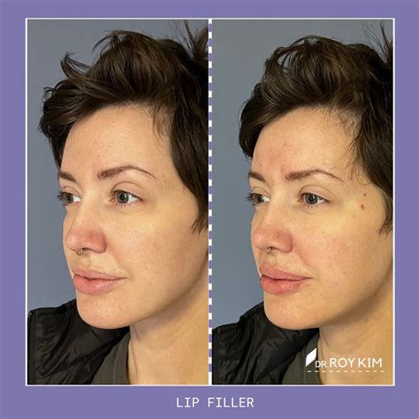 The Art and Science of Lip Filler: Achieving Natural Beauty – Roy Kim, MD