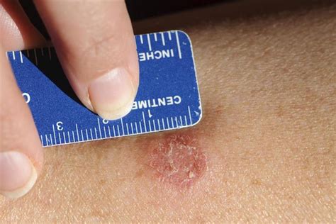 Fungal Skin Infection Hands