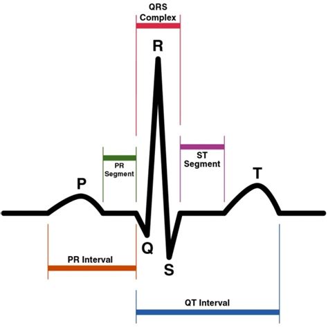 Депрессия сегмента ST — E-Cardio