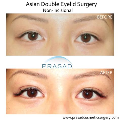 Double Eyelid Surgery (Asian Eyelid Surgery) in New York