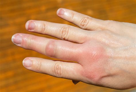 Severe Bee Sting Swelling