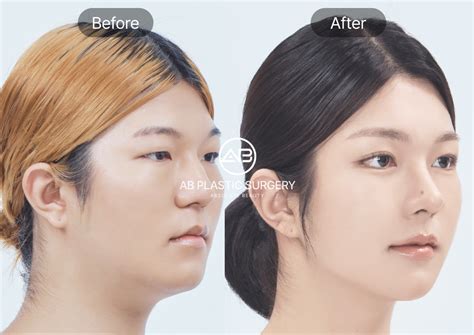 bulbous nose rhinoplasty korea