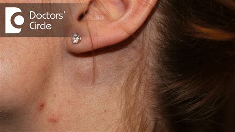 Swollen Lymph Node In Front Of Ear - vrogue.co