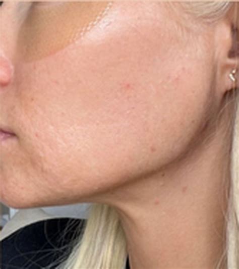 BBL Treatments | Laser Clinics New Zealand