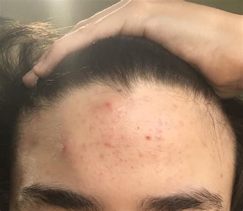 [Acne] What else can I do to help my forehead : r/SkincareAddiction