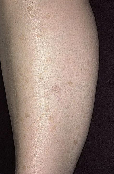 Кератоз на ногах фото – 75 шт. / fotodiagnoz.com