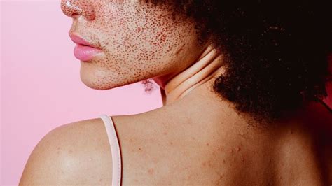 red spots  skin dermatologists explain marie claire