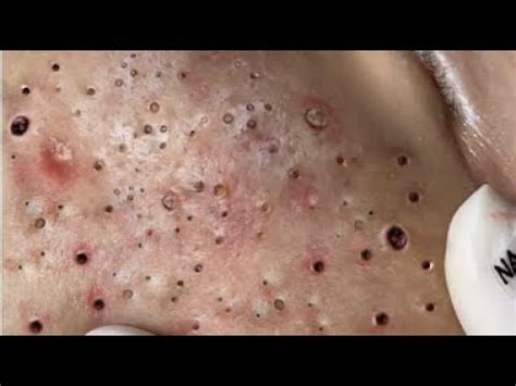 Unbelievable Blackhead Removal 2024: The Science Behind the Hype - s78amis