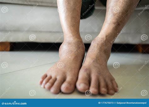 Asian Senior Woman Is Show Her Swollen Feet Or Legs In The Area Of Astragalus,elderly Patient ...