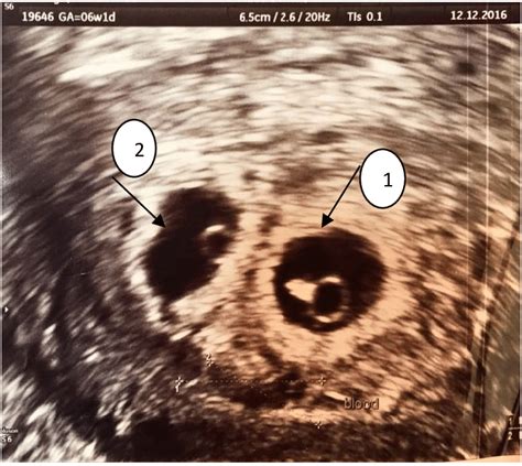 Ultrasound examination showed an intrauterine twin pregnancy (1, 2) at ...