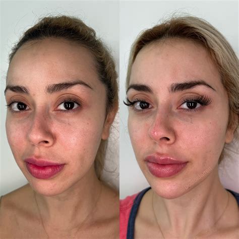 Facial Balancing - Designer Aesthetics by Dr. Jarrett Schanzer | Miami
