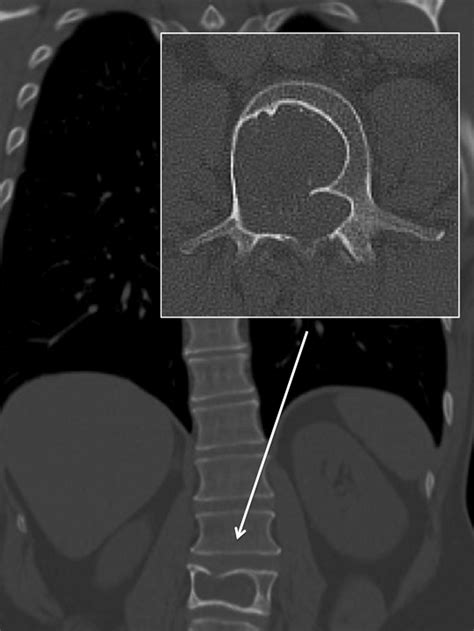 Giant spinal schwannoma: complete excision and one-step posterior