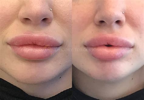 Botox Lips Before After | Lipstutorial.org