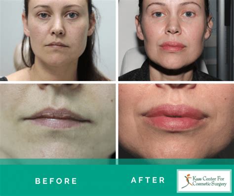 Permanent Lip Filler Before And After - Infoupdate.org