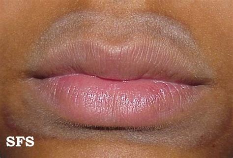 Red Rash Around Lips | Lipstutorial.org