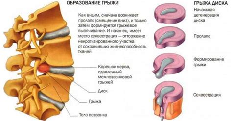 Секвестрированная грыжа поясничного отдела позвоночника: грыжа диска l5 ...