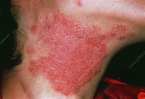 fungus infection humans  harold zendejas blog