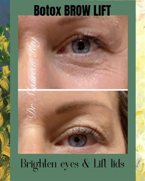 What Is A Botox Eye Lift at Lucile Hart blog