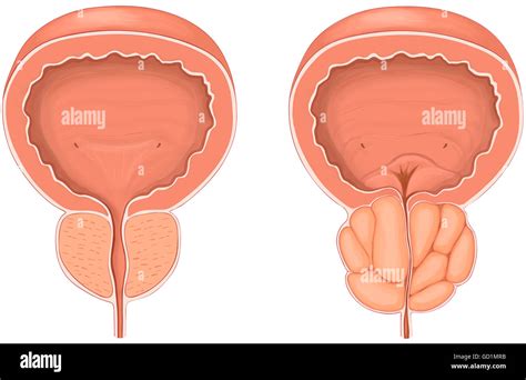 Anterior view showing normal versus enlarged prostate gland Stock Photo - Alamy