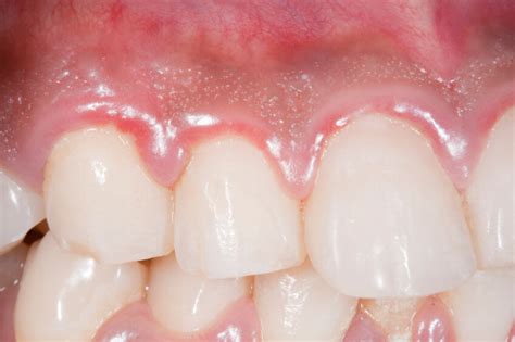 What is Gingivitis? Gingivitis Symptoms and Treatment