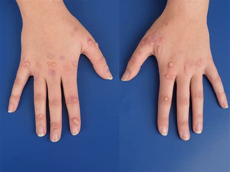 Verruca Plana Icd 10