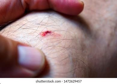 Bloody Wounds Skin Wound Blood Flow Stock Photo 1472629457 | Shutterstock