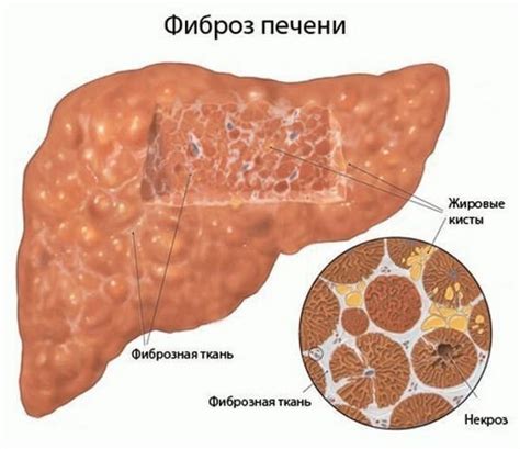 Фіброз печінки 1, 2, 3, 4 ступеня: симптоми, причини, шкала метавір ...