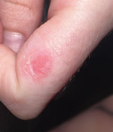 Is this gone yet 😭 : r/Warts