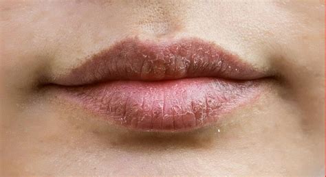 Labios Rachados O Que Passar - Lábios Rachados: dicas e cuidados