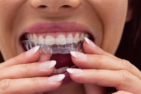 Benbrook Orthodontics Treatment | Braces | Perkins Orthodontics