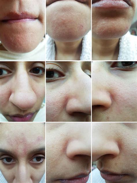 Unbelievable Blackhead Removal 2024: Is It Worth The Hype? (Honest Review) Image 17