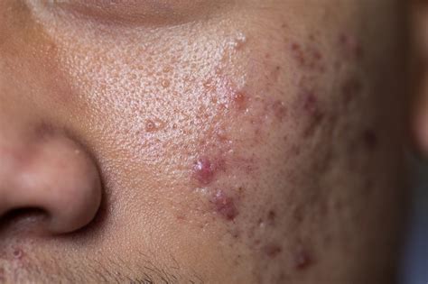 What Is The Best Treatment For Acne Scars? - Linia Skin Clinic