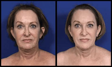 Thread Lift Before and After Photo Gallery | Dr. Kane