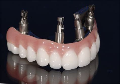 implant supported full arch restoration wiand dental lab